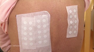 Rücken eines Patienten auf dem Pflaster für einen Kontaktallergie-Test aufgebracht sind.