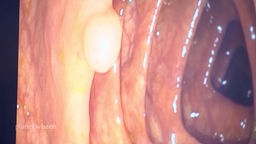 Darmspiegelung: Blick in einen Darm, in dem sich ein heller Polyp an der Darmwand befindet.