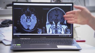 Laptop auf einem Schreibtisch, auf dem Monitor erkennt man Schnittbilder eines menschlichen Gehirns.