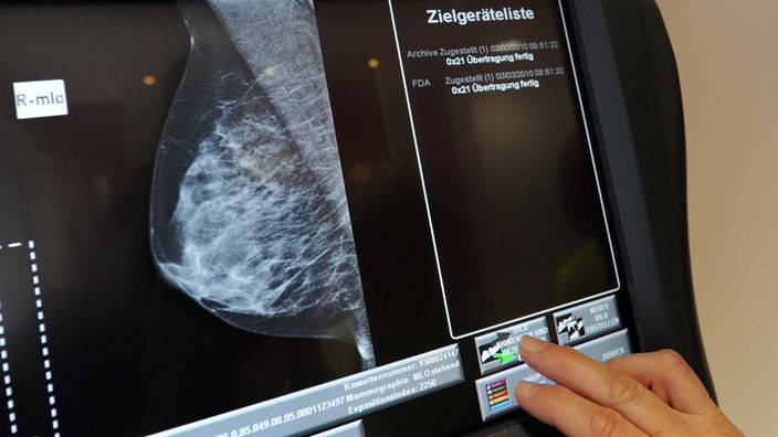 Ein Radiologe untersucht eine Mammographie-Aufnahme der Brust einer Patientin